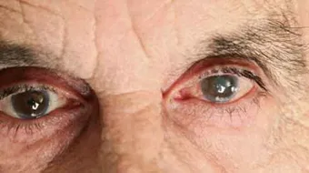 علاج الماء الأبيض في العين - فيديو