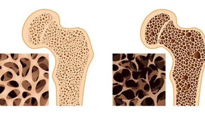 وصفة طبيعية لعلاج هشاشة العظام