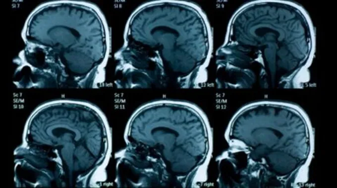 ضمور المخ عند الأطفال