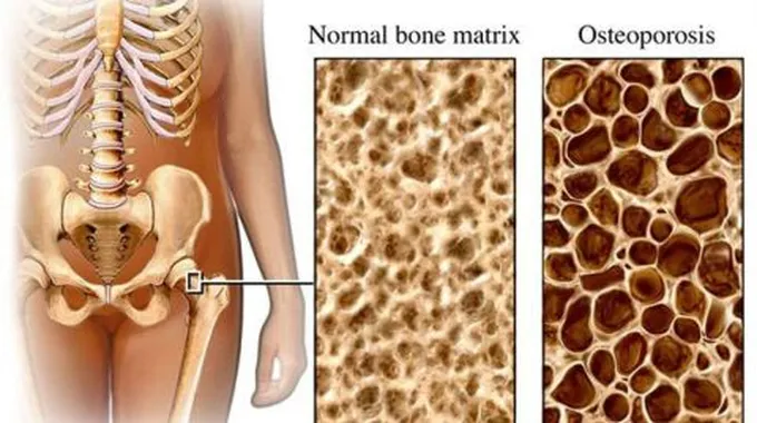أسباب هشاشة العظام وعلاجها