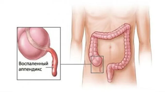 أسباب التهاب الزائدة الدودية