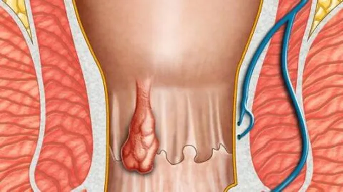 أسباب البواسير عند الرجال