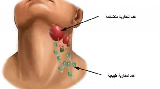 أسباب التهاب الغدد اللمفاوية