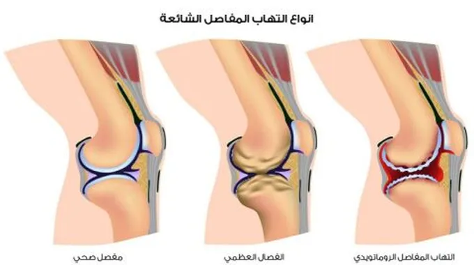 أسباب آلام المفاصل