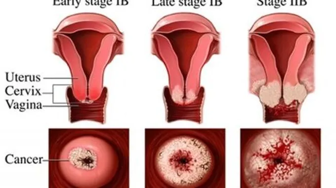 سرطان عنق الرحم اعراض