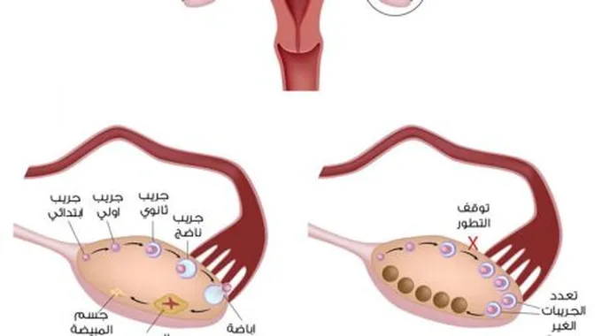 الأكياس على المبايض وكيف يمكن علاجها