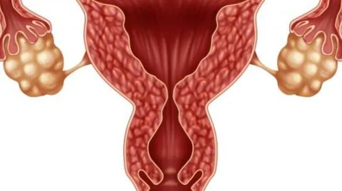 مشروب لعلاج تكيس المبايض