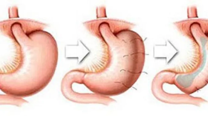 أضرار عملية تكميم المعدة