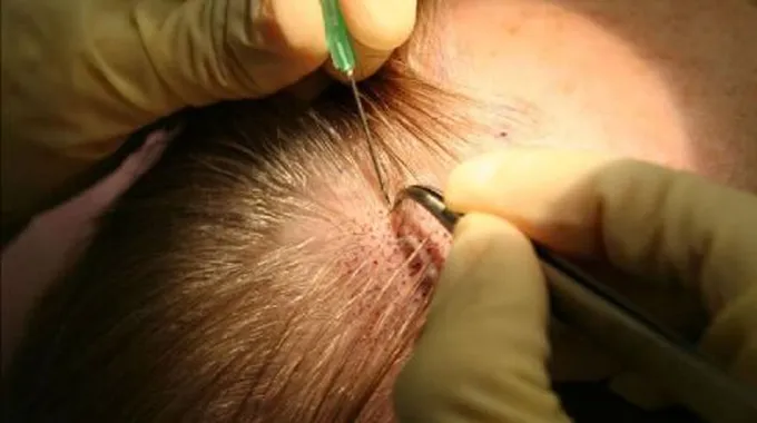 طريقة زراعة الشعر