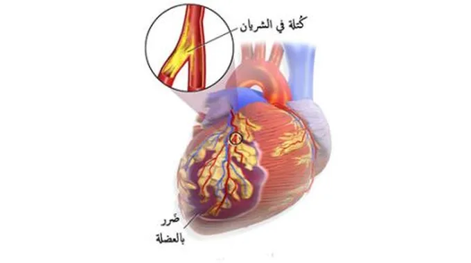 ارتجاع صمام القلب