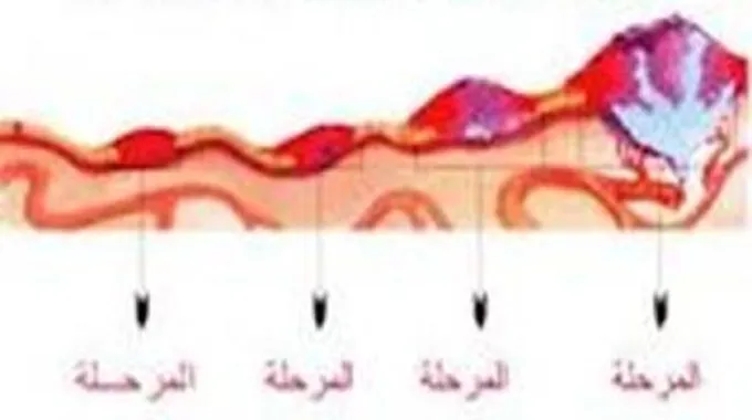 كم عدد مراحل مرض السرطان