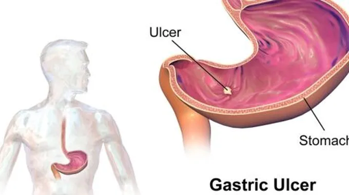 كيفية التخلص من قرحة المعدة