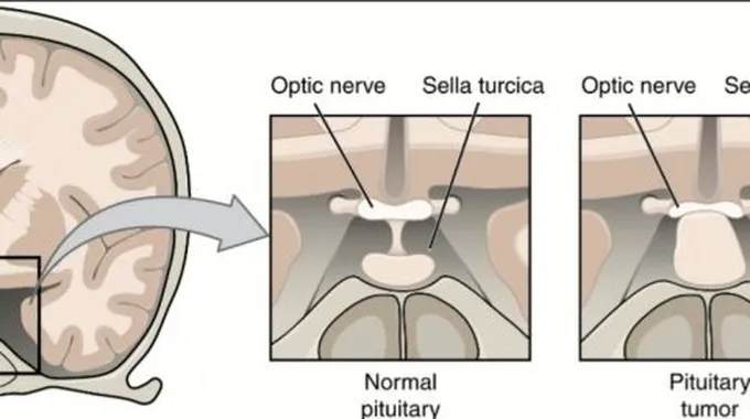 كيفية علاج ورم الغدة النخامية