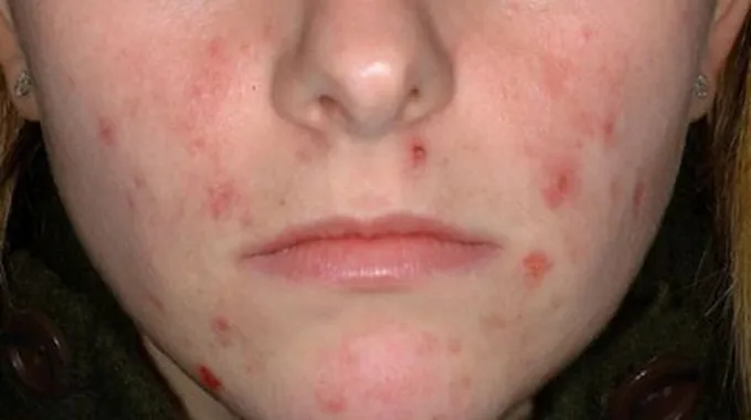 كيف تعالج حب الشباب للبشرة الدهنية