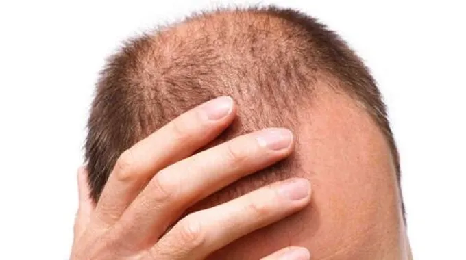 هل زراعة الشعر لها أضرار