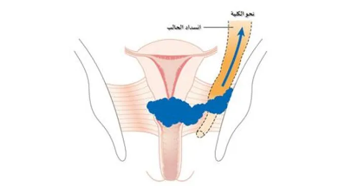 أورام الرحم الخبيثة