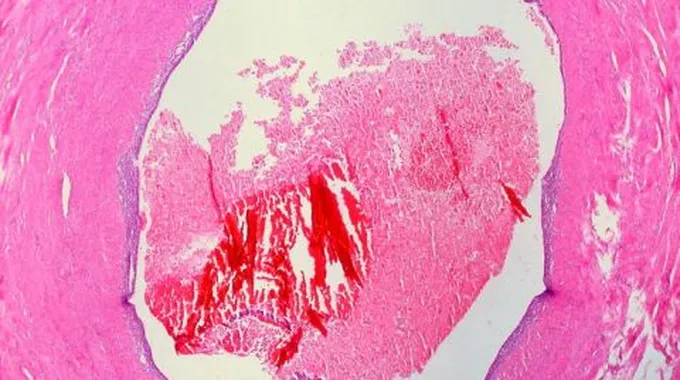 طرق علاج بطانة الرحم المهاجرة