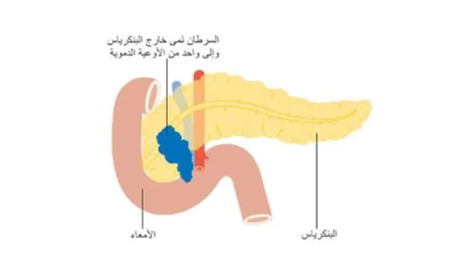 أورام البنكرياس وأعراضه