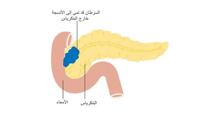 أورام البنكرياس