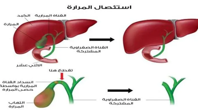 غذاء ما بعد عملية المرارة