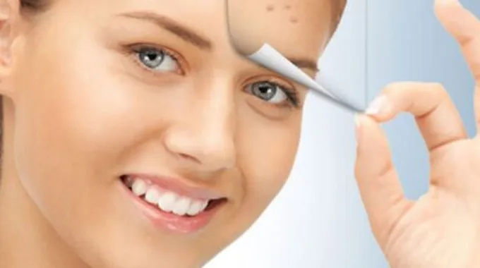 وصفات لعلاج حب الشباب للبشرة الدهنية