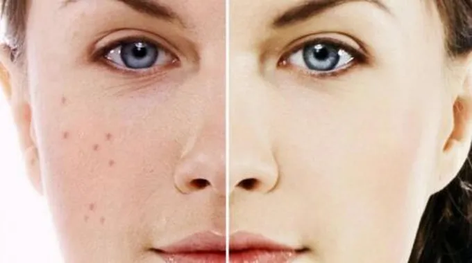 إزالة حب الشباب