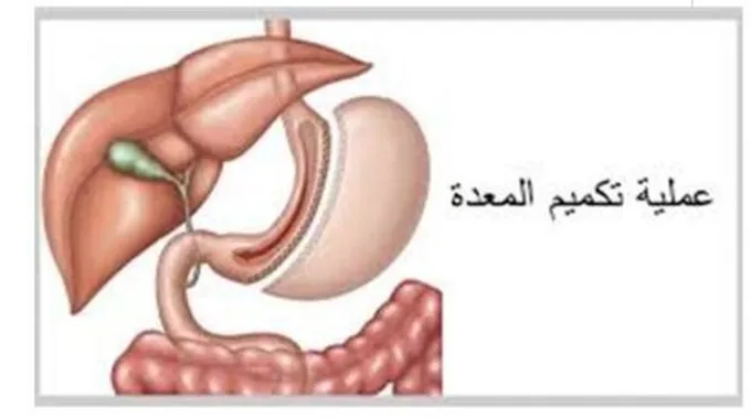 تكميم المعدة