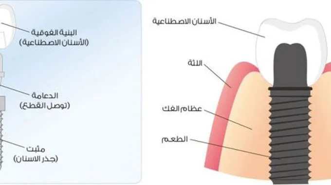 مراحل زراعة الأسنان