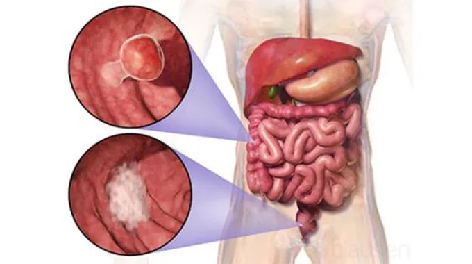 أعراض وجود ورم في القولون