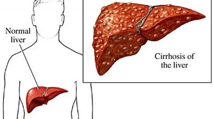 أعراض مرض فيروس C