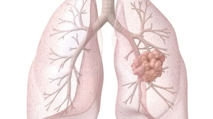 أعراض مرض سرطان الرئة