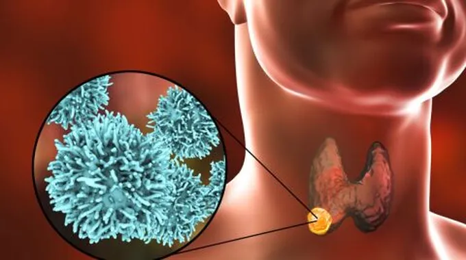 أعراض السرطان الغدة الدرقية