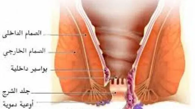 أسباب البواسير وعلاجها