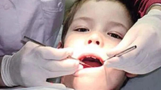 نصائح بعد خلع الضرس