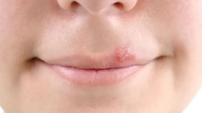 علاج الحبوب حول الفم