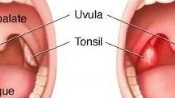 علاج تضخم اللوز عند الأطفال