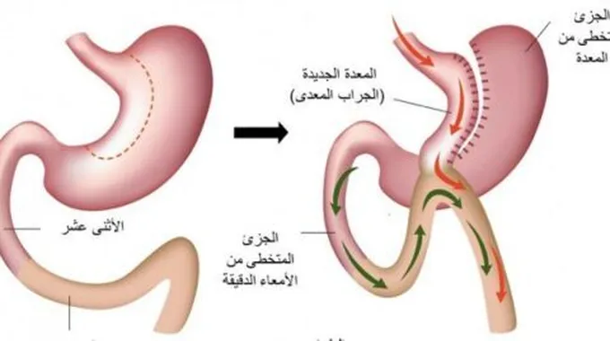 تحويل مسار المعدة