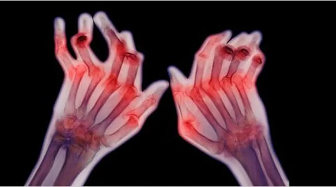 ما أسباب الروماتيزم