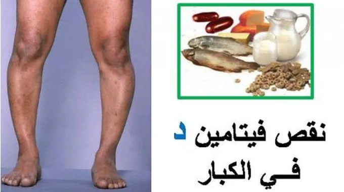 ما هو لين العظام