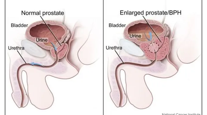 ما هو سبب مرض البروستات