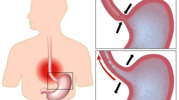 ما هو علاج فتق المعدة